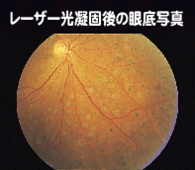 レーザー光凝固術
