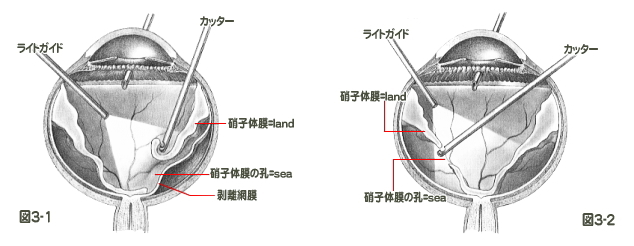 硝子体手術